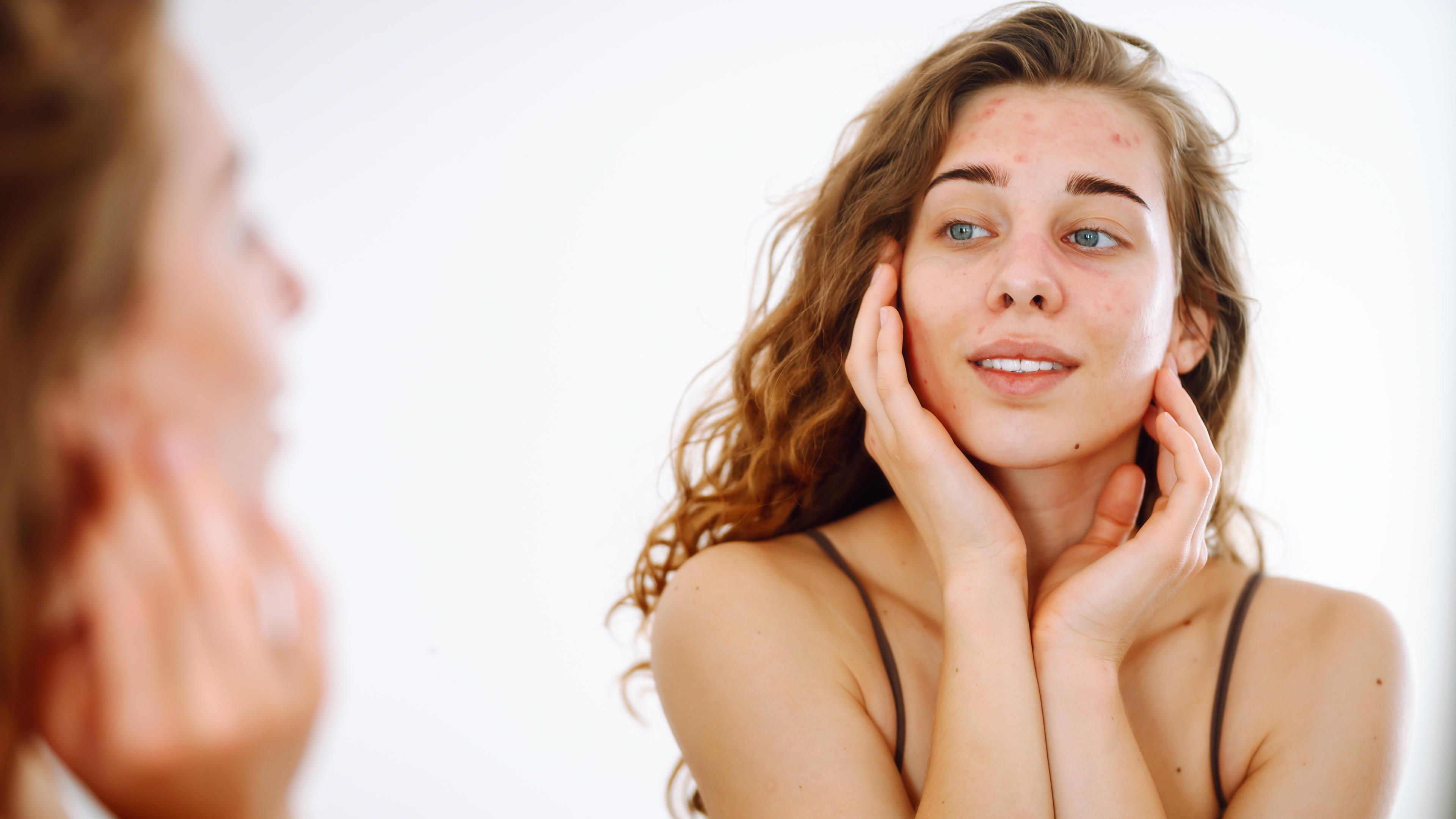 Akne og uren hud kostplan